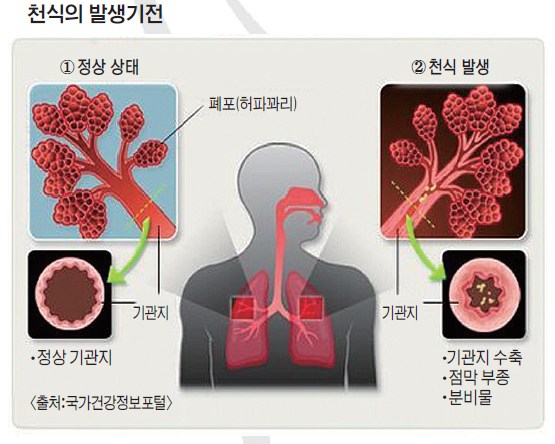 ▲ 의학-천식기전