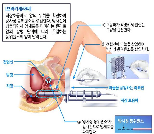 ▲ 브라키테라피 시술 모식도. 사진=분당차병원 제공