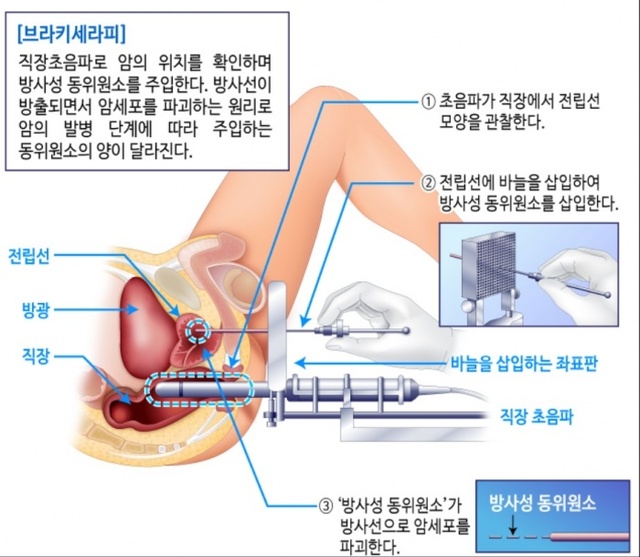 ▲ 브라키테라피 수술 모식도