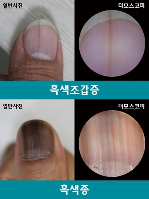 ▲ 흑색조갑증 흑색종 비교사진. 서울대병원