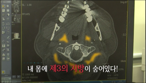 '생로병사의 비밀' 숨어 있는 지방의 경고, 이소성지방. KBS 1TV