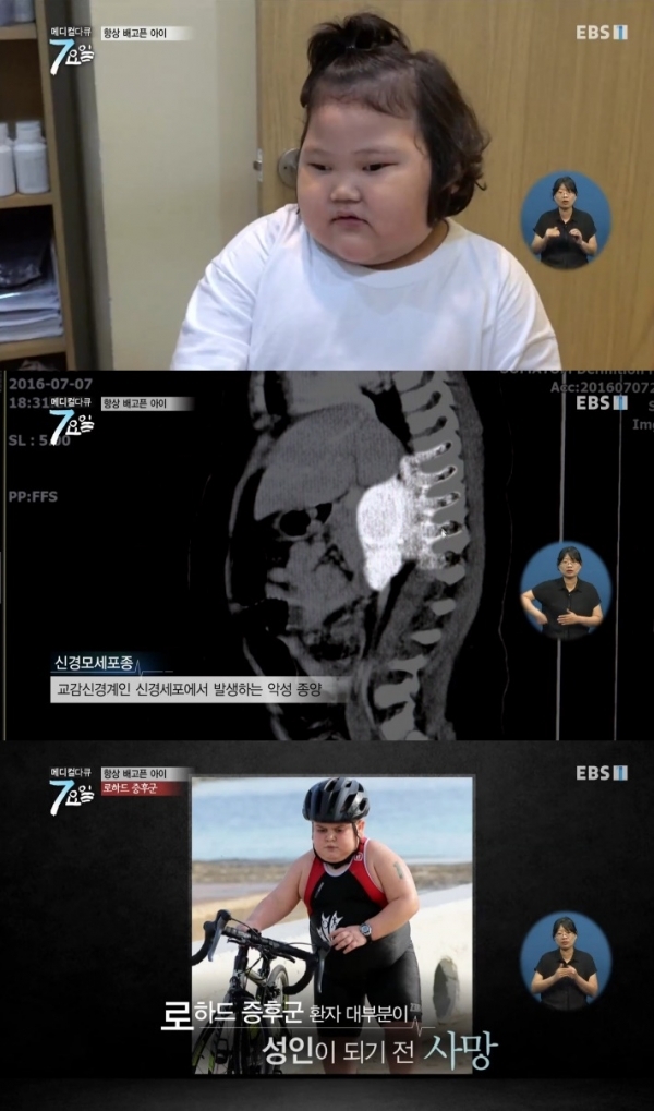 희귀병인 로하드 증후군에 대한 관심이 모이고 있다. EBS '메디컬다큐 7요일' 방송 캡처