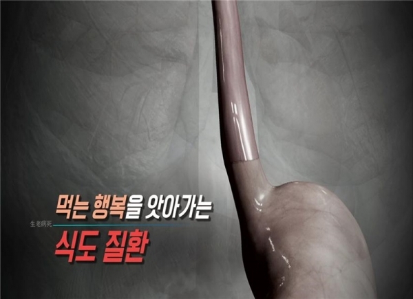'생로병사의 비밀' 먹는 행복을 앗는 식도질환. KBS 1TV