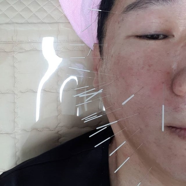 지석진이 안면 침 시술 인증샷을 공개했다. 지석진 인스타그램