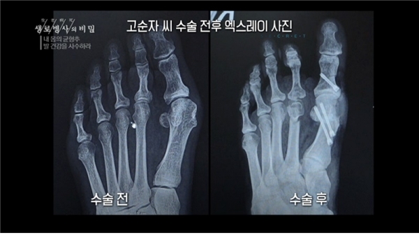 '생로병사의 비밀'. KBS 1TV