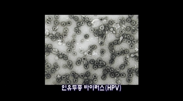 HPV(사람유두종바이러스). EBS