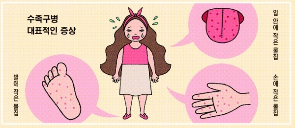 야외 활동으로 수족구병 환자 증가