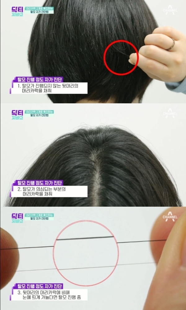 '닥터 지바고'에서는 탈모 자가진단법이 소개됐다. 방송 캡처