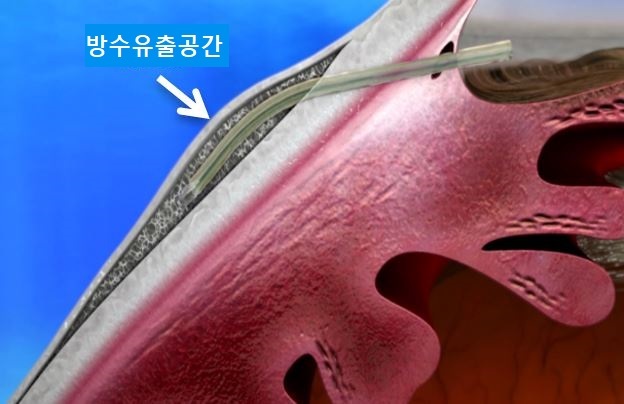 ▲ 첨부1_녹내장_스텐트_삽입술_이미지_1