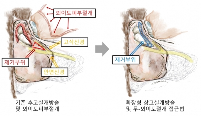 ▲ 만성중이염 수술법 비교 이미지