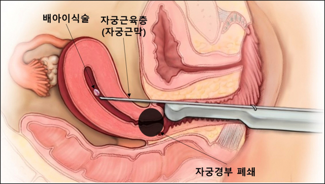 자궁근막 통과 배아이식술