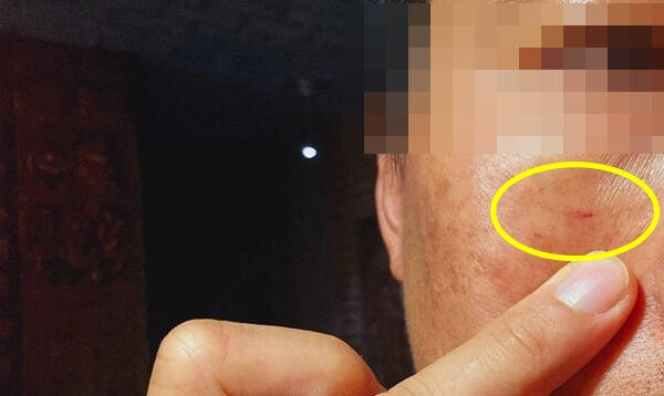 치킨집을 운영하는 한 자영업자가 손님으로부터 아무 이유 없이 폭행을 당했다고 억울함을 호소했다. 사진은 폭행으로 얼굴에 상처를 입은 모습. 온라인 커뮤니티 갈무리