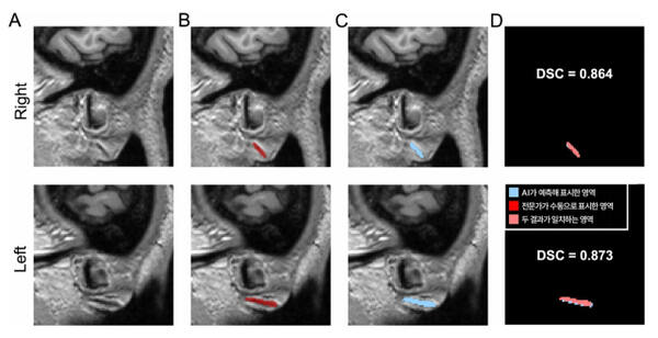 3차원 이미지를 토대로 전문가가 수동으로 직접 표시한 주름과 AI가 예측해 자동으로 표시한 영역. 분당서울대병원 제공